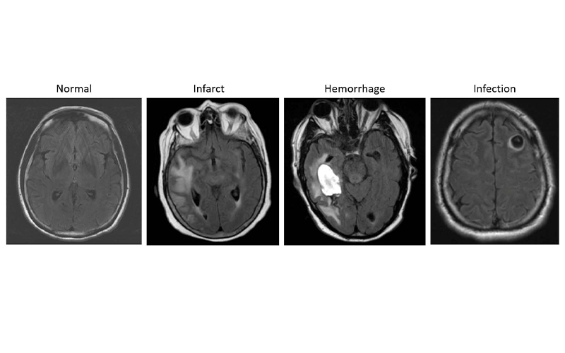 AIRM Brain Tumor System